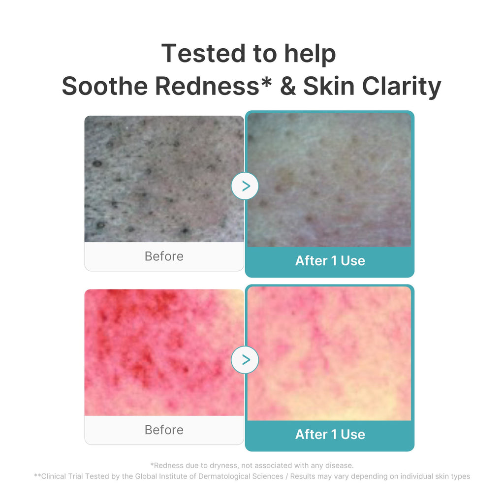 Azelaic Acid Capsule Foam Cleanser - Your Daily Care Pick